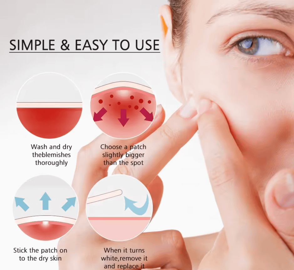 Salicyclic Acid + Tea Tree Oil Invisible Acne Patches - 48 Patches Day & Night Protection - Image 4